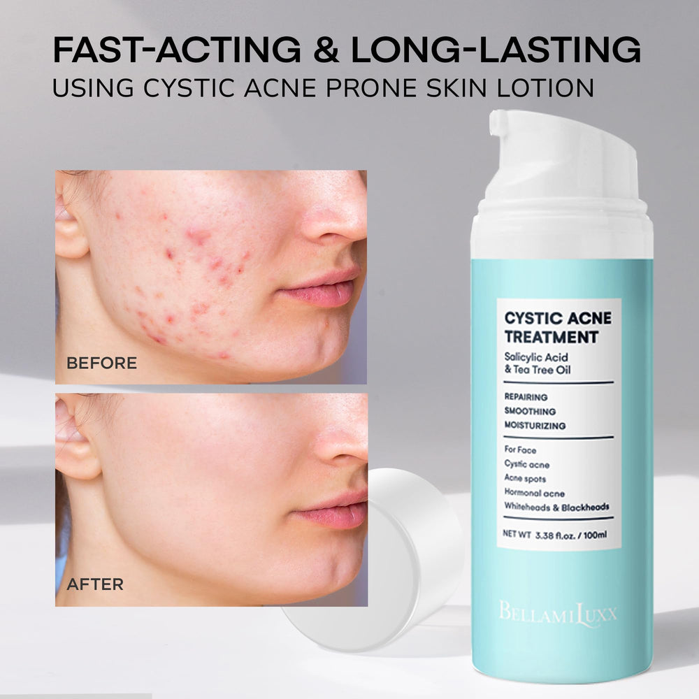 BellamiLuxx cystic acne texture close-up reveals lightweight non-greasy hydration.