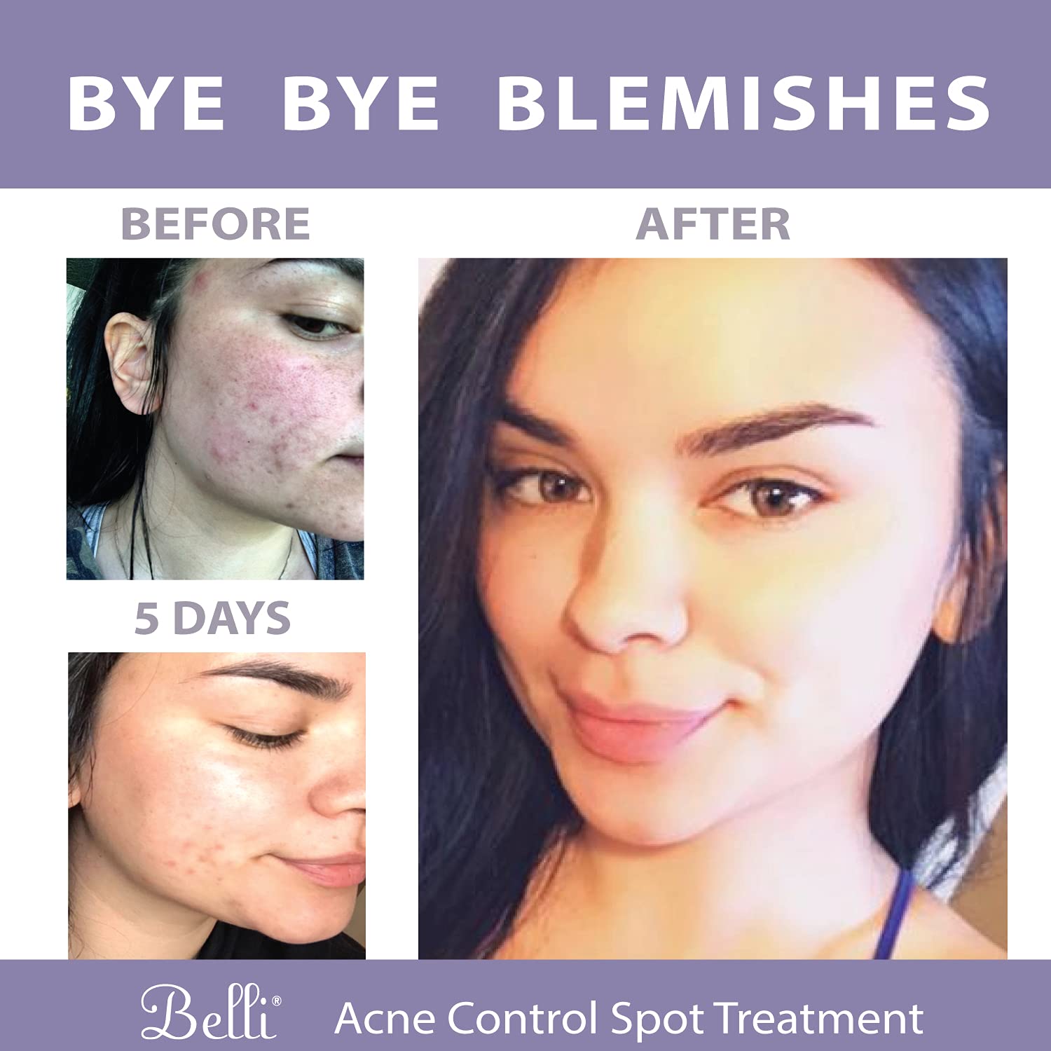 Belli Acne Control Spot Treatment on a routine kit, showcases daily skincare integration.
