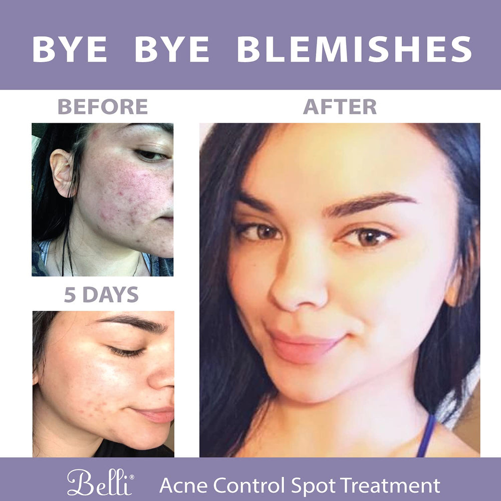 Belli Acne Control Spot Treatment on a routine kit, showcases daily skincare integration.