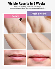 BETNEP IPL laser removal device handheld usage demonstrates comfortable grip during quick sessions.