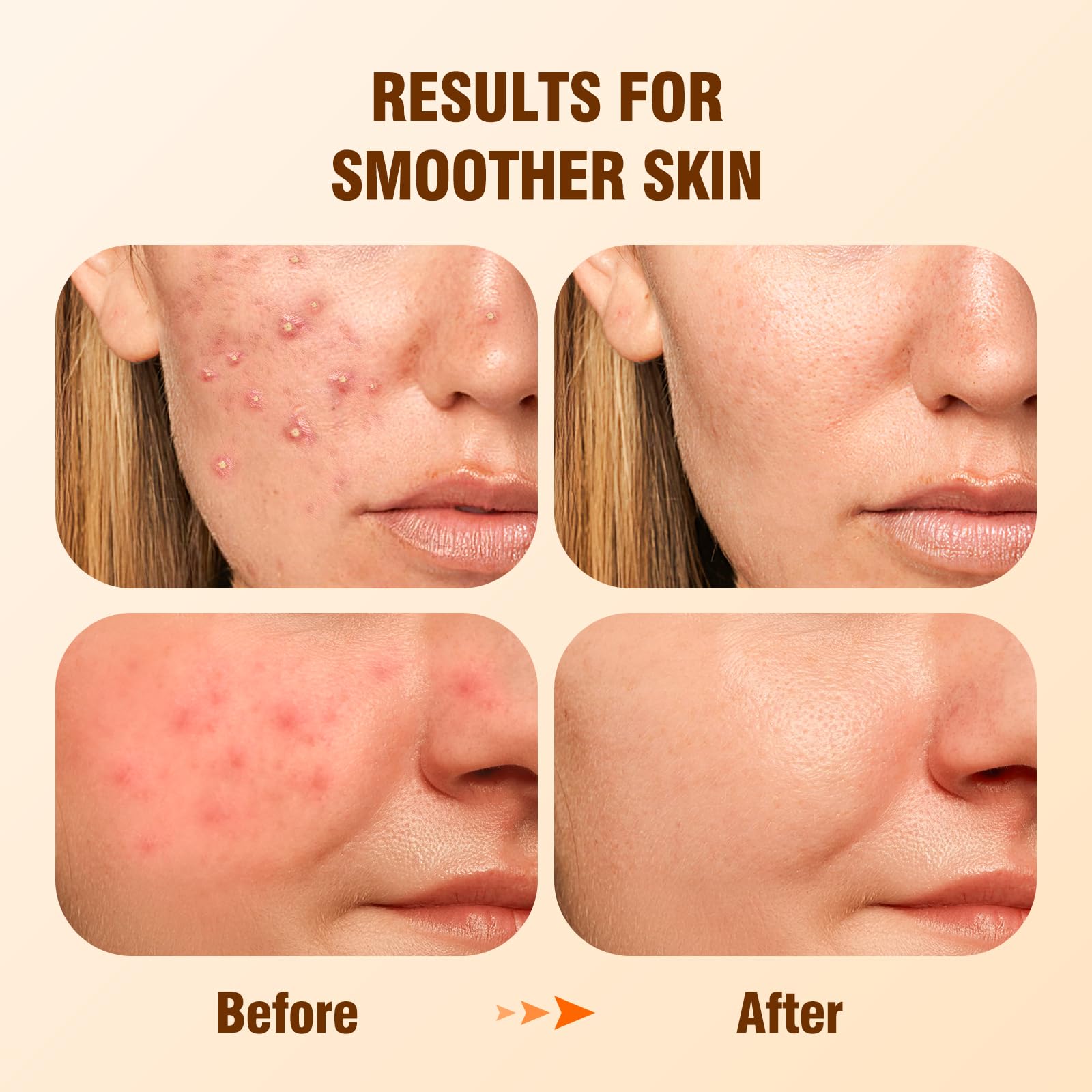BIYSBER Salicylic Acid 2% Serum dropper image demonstrates precise application for oil control.
