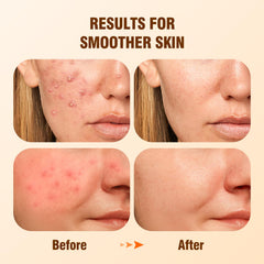 BIYSBER Salicylic Acid 2% Serum dropper image demonstrates precise application for oil control.