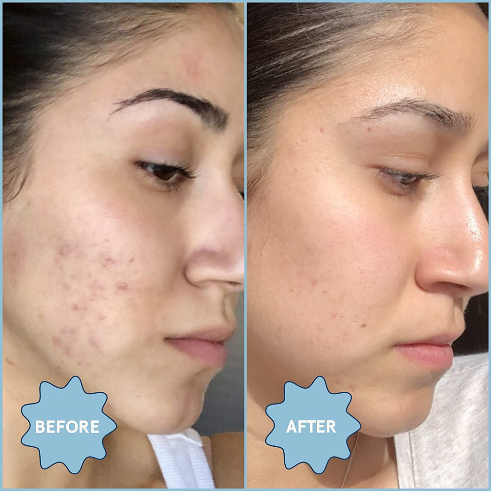 Blume Meltdown spot-treatment with moisturizer for blemish prevention.