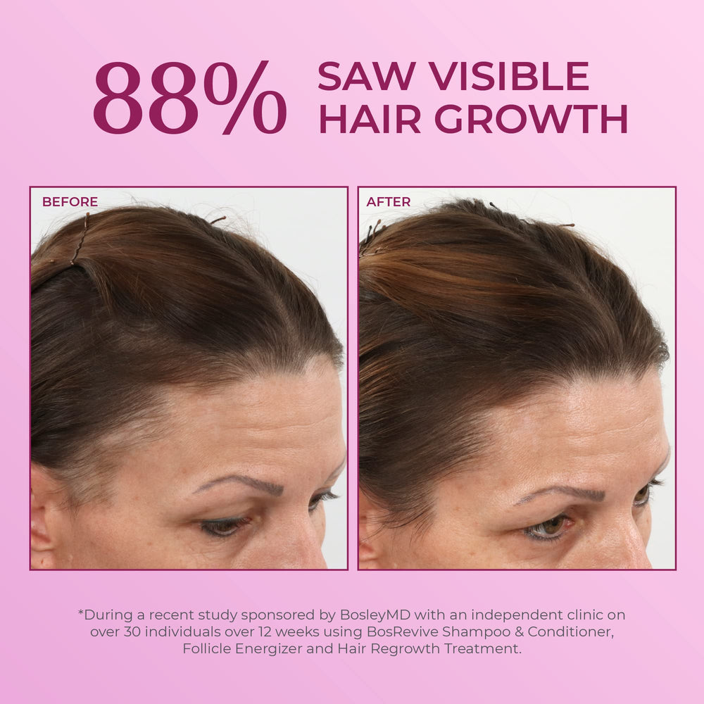 BosleyMD Minoxidil Woman Spray dropper reminder helps accurate dosing for regrowth.