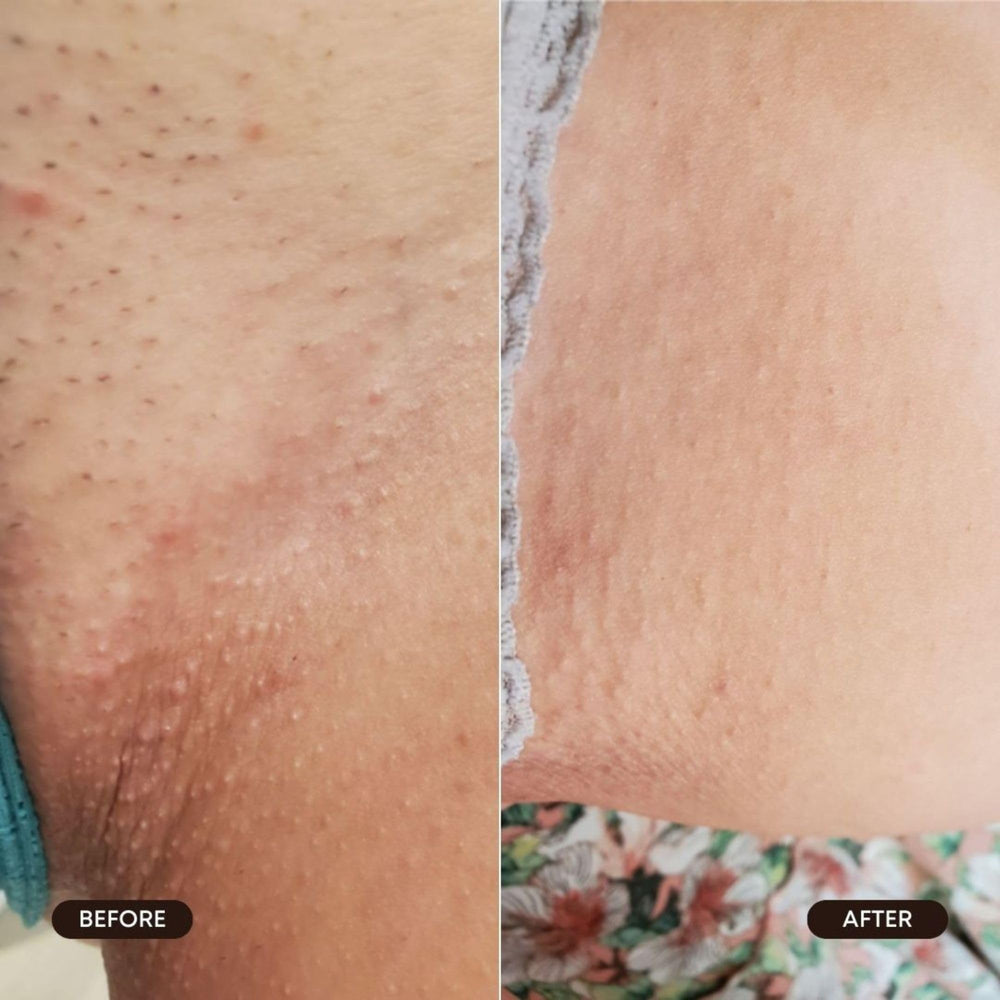 Bushbalm Roller Rescue AHA/BHA exfoliation for skin refinement