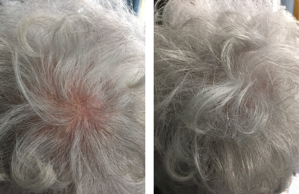 Caboki bald-spot concealment blends seamlessly with existing hair.