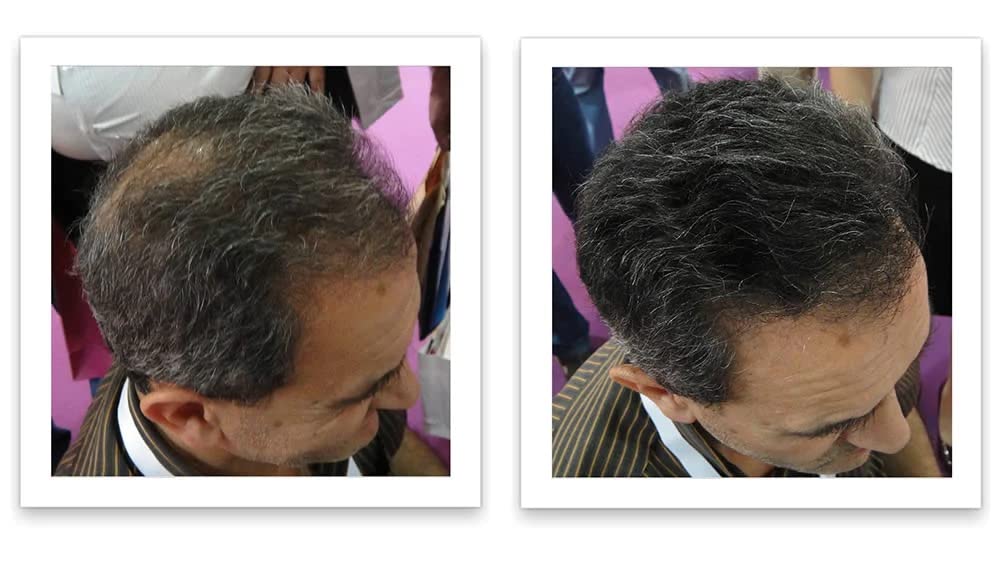 Caboki before-after thinning hair density shows improved fullness