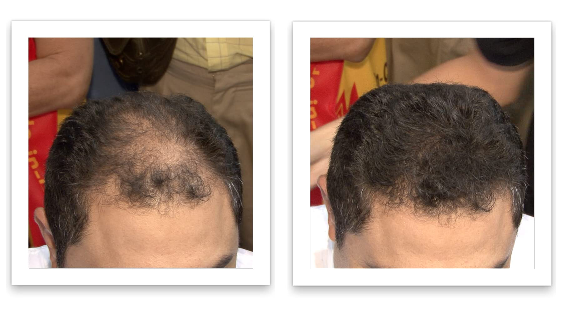 Caboki on thinning area shows seamless blend with existing hair.