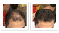 Caboki on thinning area shows seamless blend with existing hair.