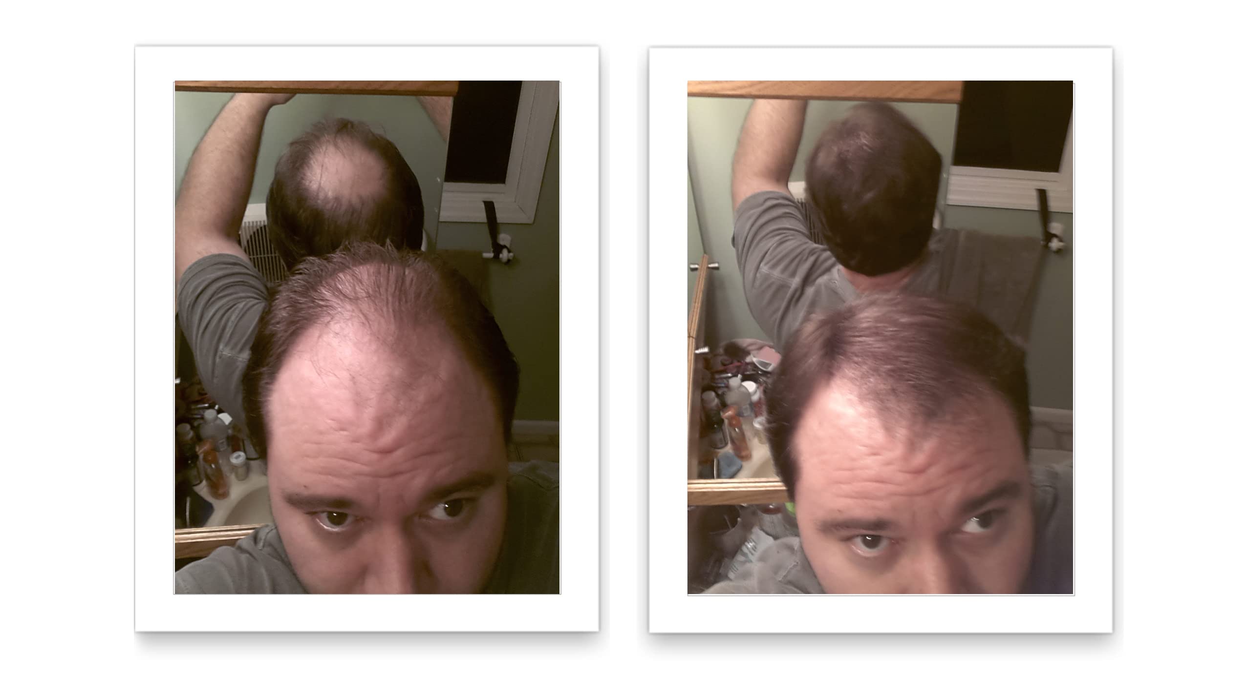 After thinning-area with Caboki for instantly fuller hair