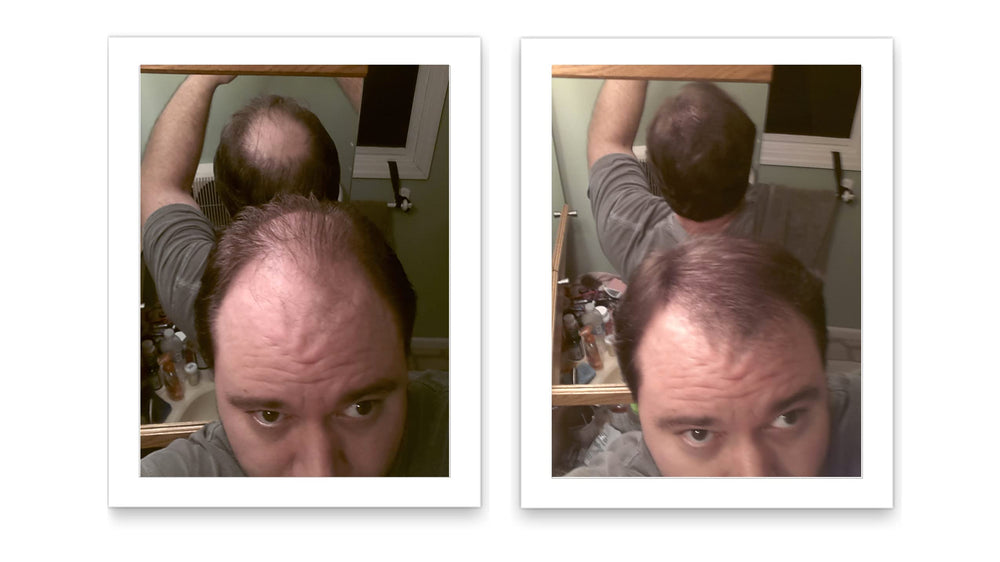 After thinning-area with Caboki for instantly fuller hair