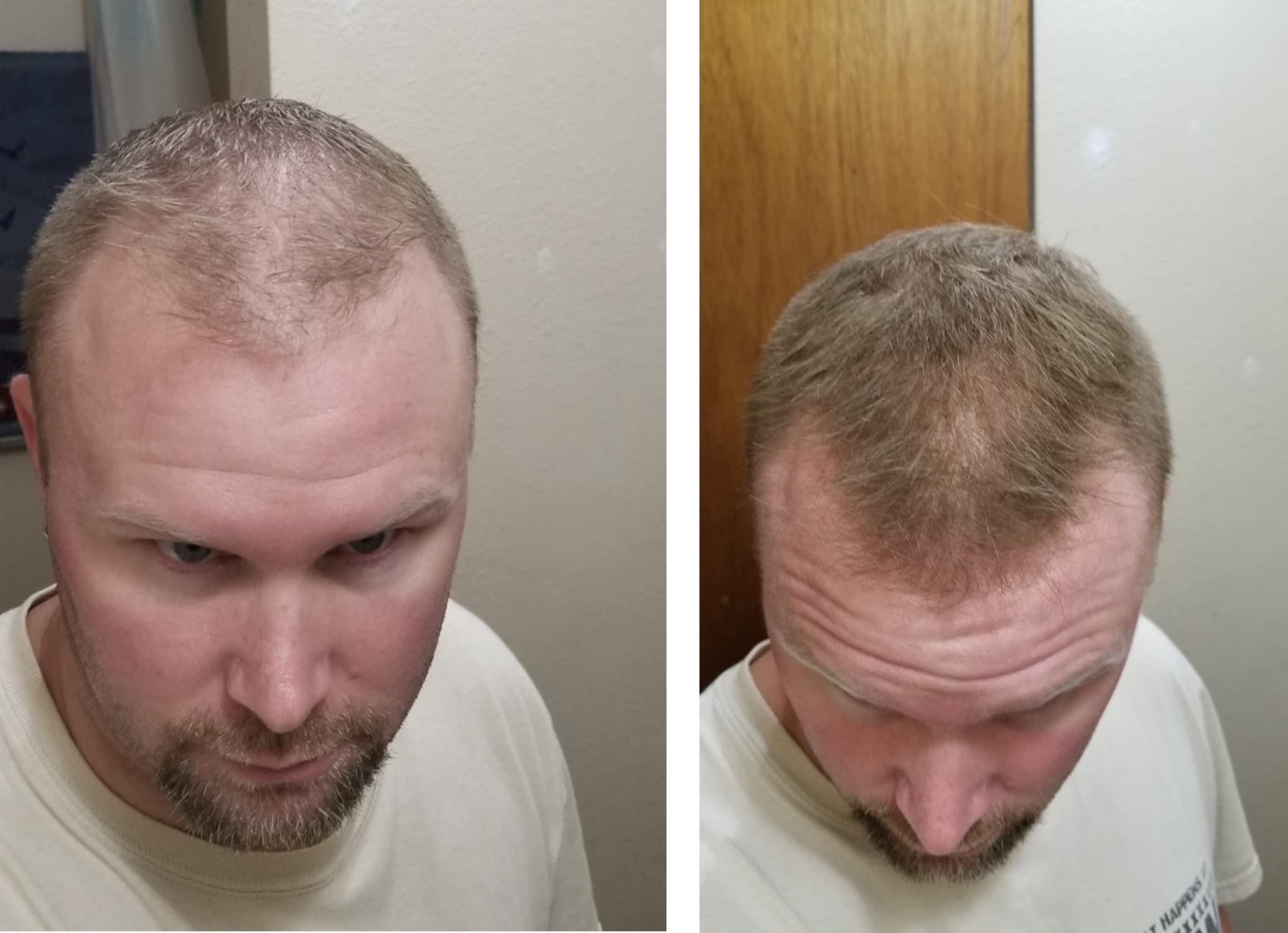 Before thinning-area image with Caboki ready to apply