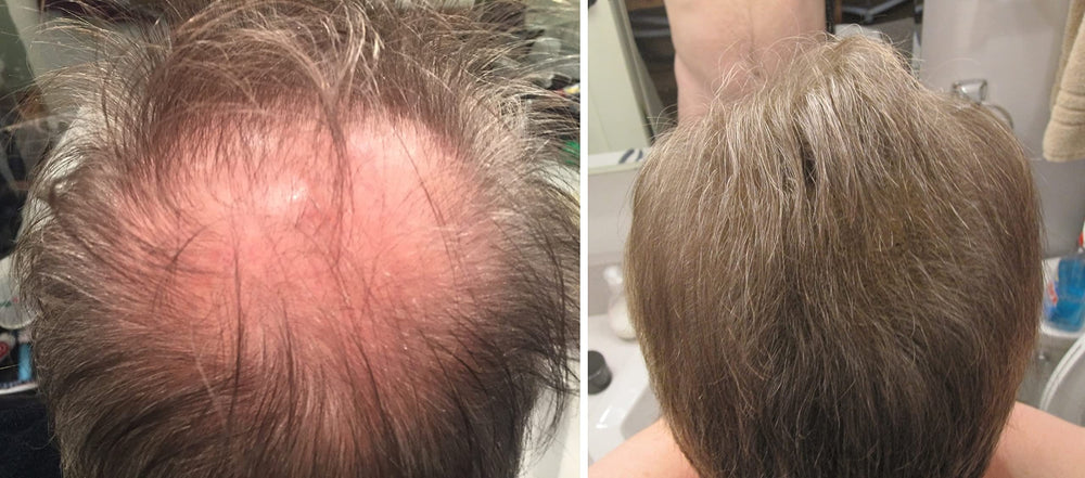 Caboki part line application widens appearance of hair.