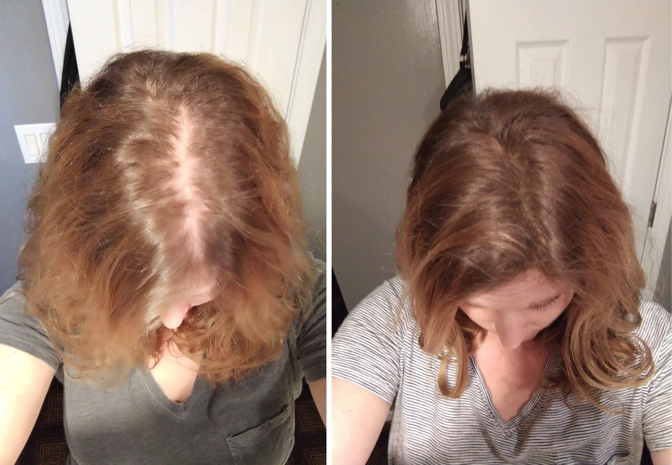 Caboki sparse hairline blending for natural fullness.