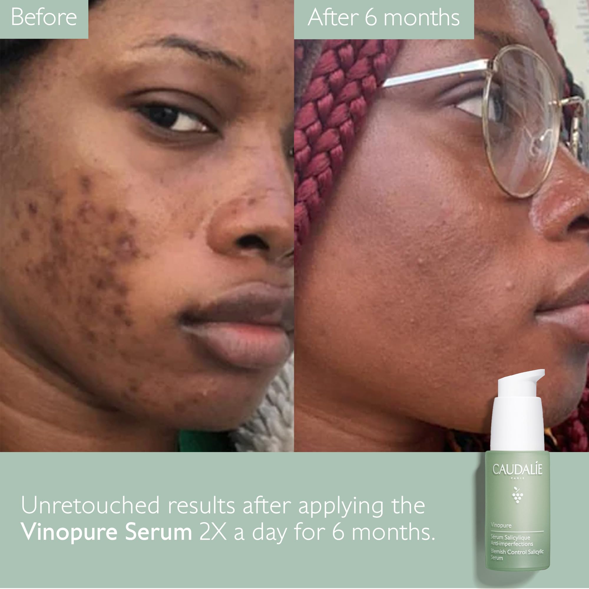 Caudalie Vinopure serum for blemish-prone skin in daily care.