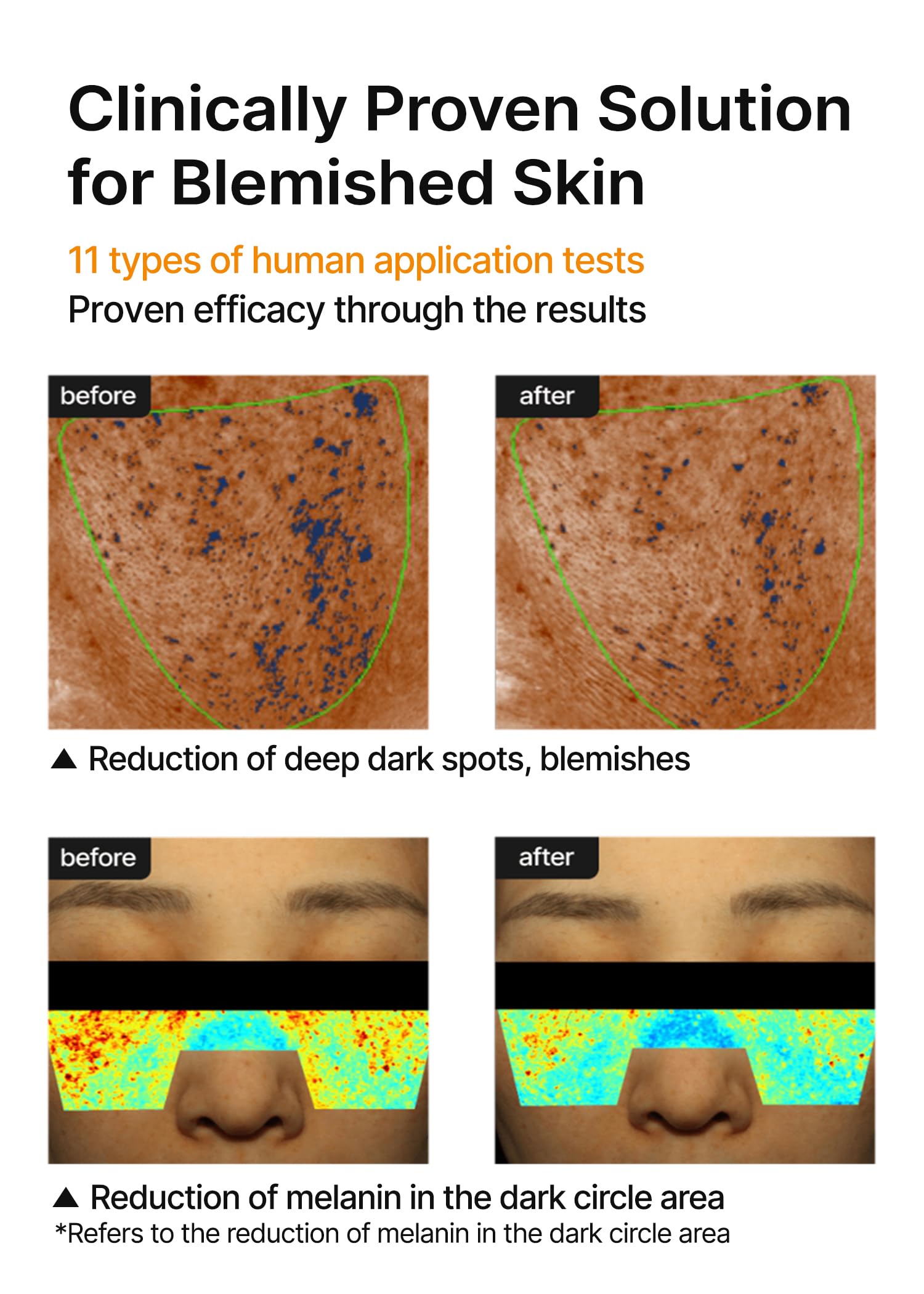 Celimax Melazero V2 formula packaging hints at advanced blemish care.