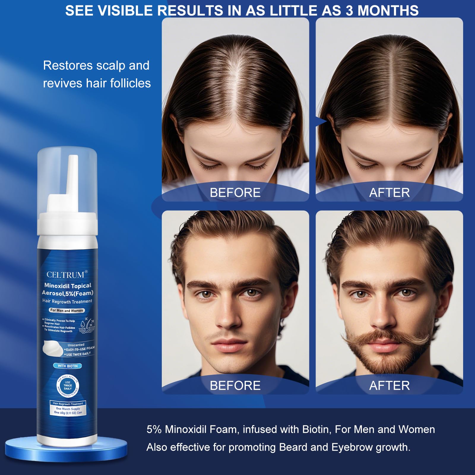 Celtrum Minoxidil Foam packaging emphasizes four-month supply for ongoing treatment.