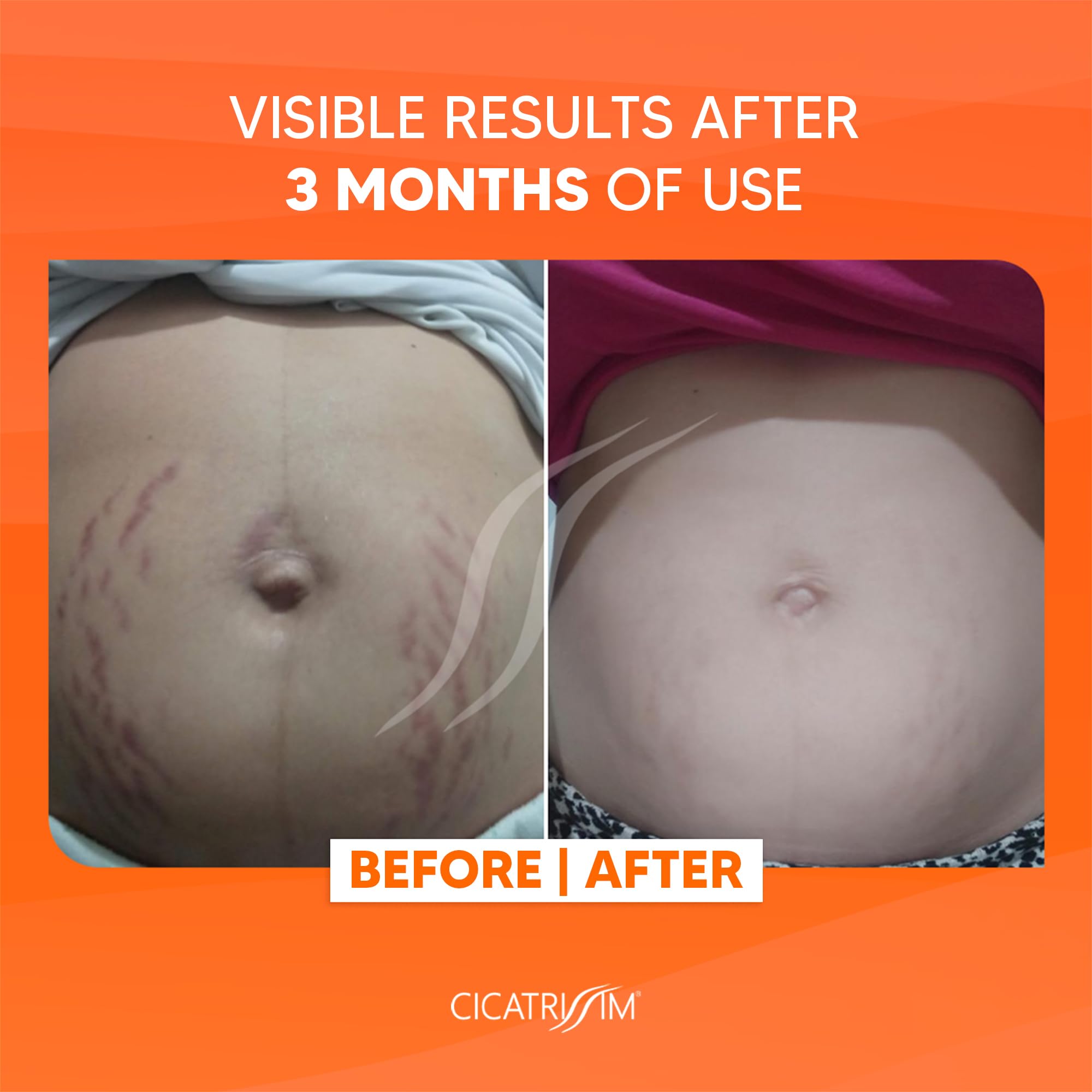 Cicatrissim stretch mark cream texture application being massaged for deep hydration without greasiness.