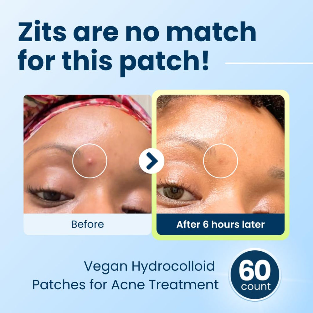 CLEAN SKIN CLUB DermaDot patch over blemish provides discreet coverage.