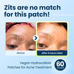 CLEAN SKIN CLUB DermaDot patch over blemish provides discreet coverage.