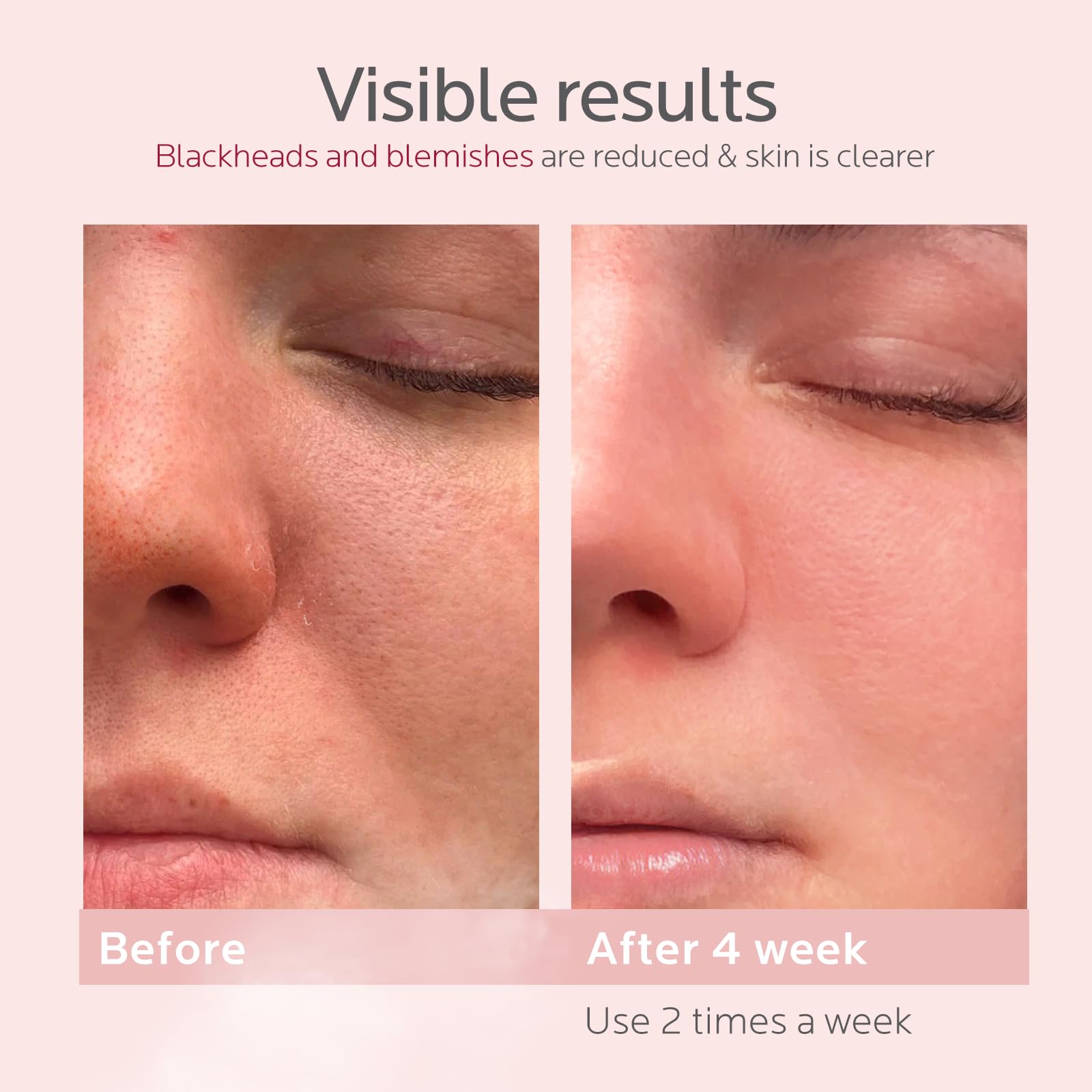 Colorfarm stainless steel blackhead remover demonstrates precision extraction potential