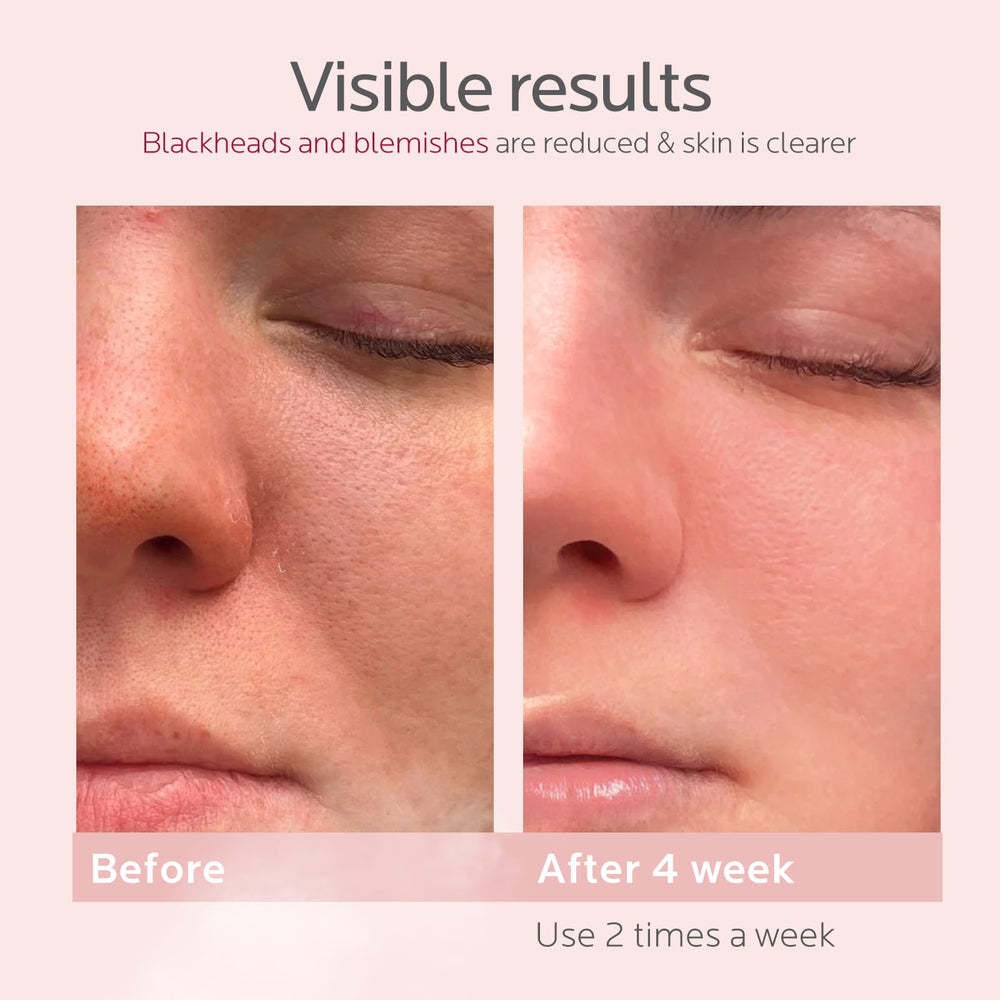 Colorfarm stainless steel blackhead remover demonstrates precision extraction potential