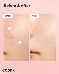 COSRX Acne Blemish Spot Drying Lotion application on skin for precise spot treatment