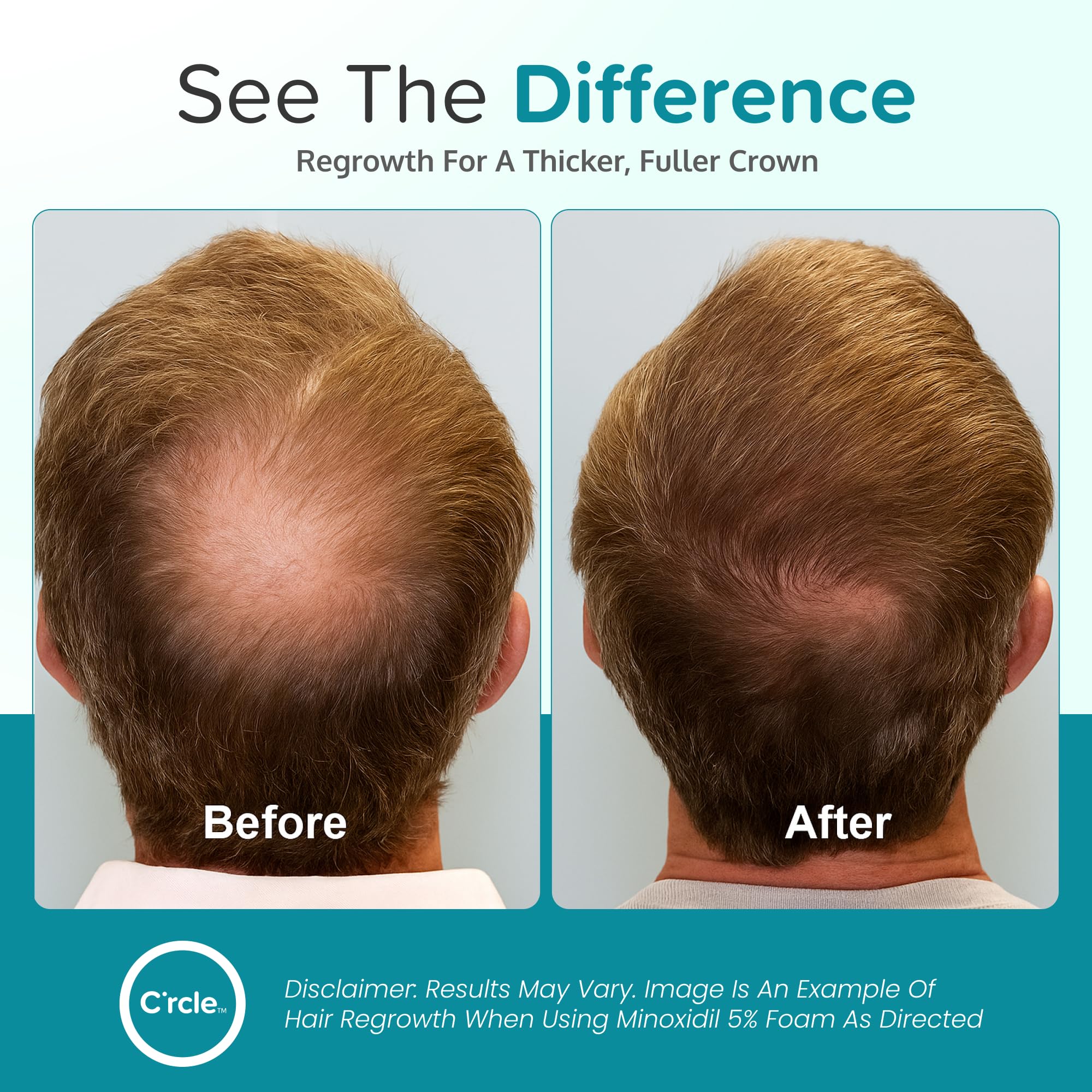crcle minoxidil foam 6 month supply image highlights long term value and coverage