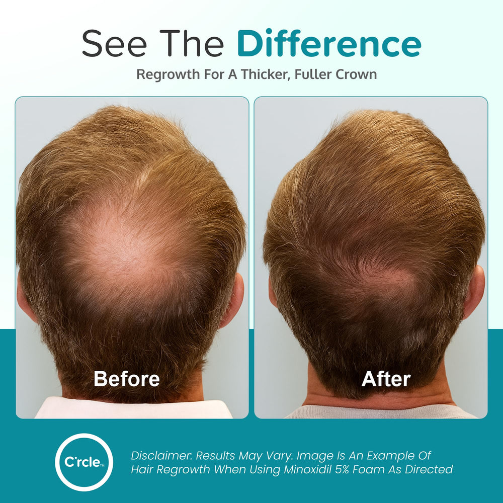 crcle minoxidil foam 6 month supply image highlights long term value and coverage