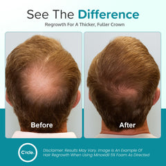 crcle minoxidil foam 6 month supply image highlights long term value and coverage