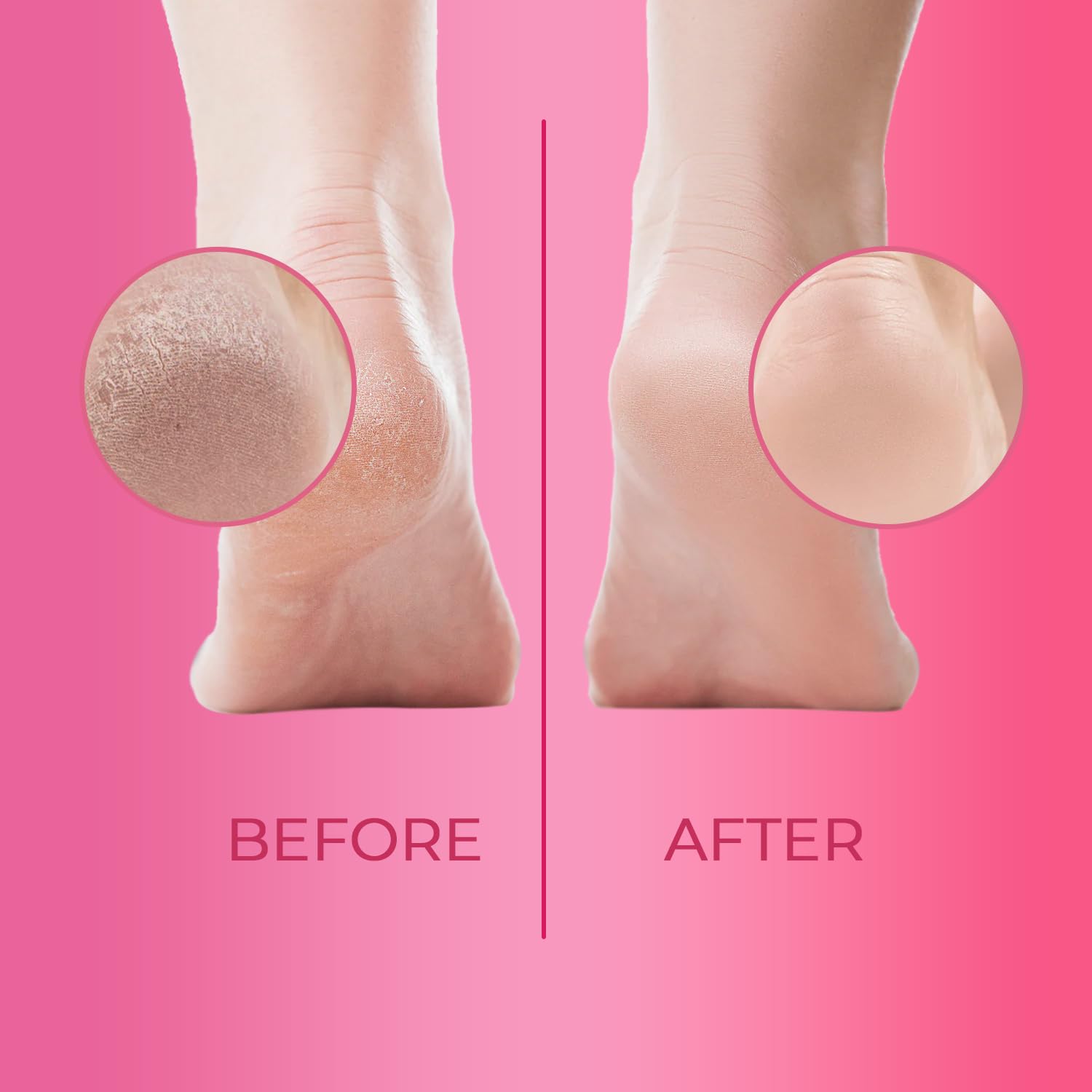Cutikles Callus Remover Gel applied to rough areas for targeted treatment.