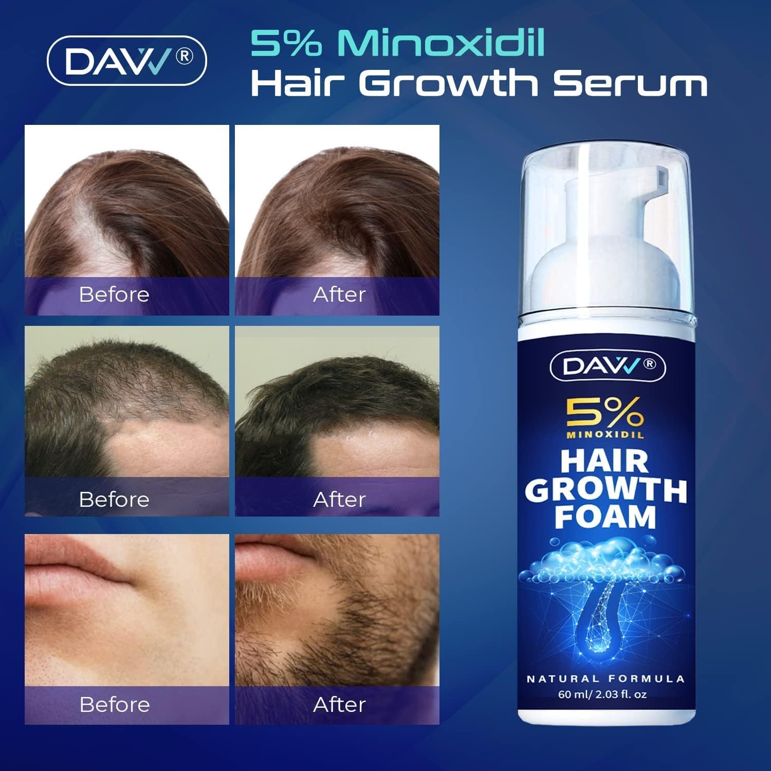 DAVV Minoxidil Foam on scalp shows quick-drying formula for fast absorption.