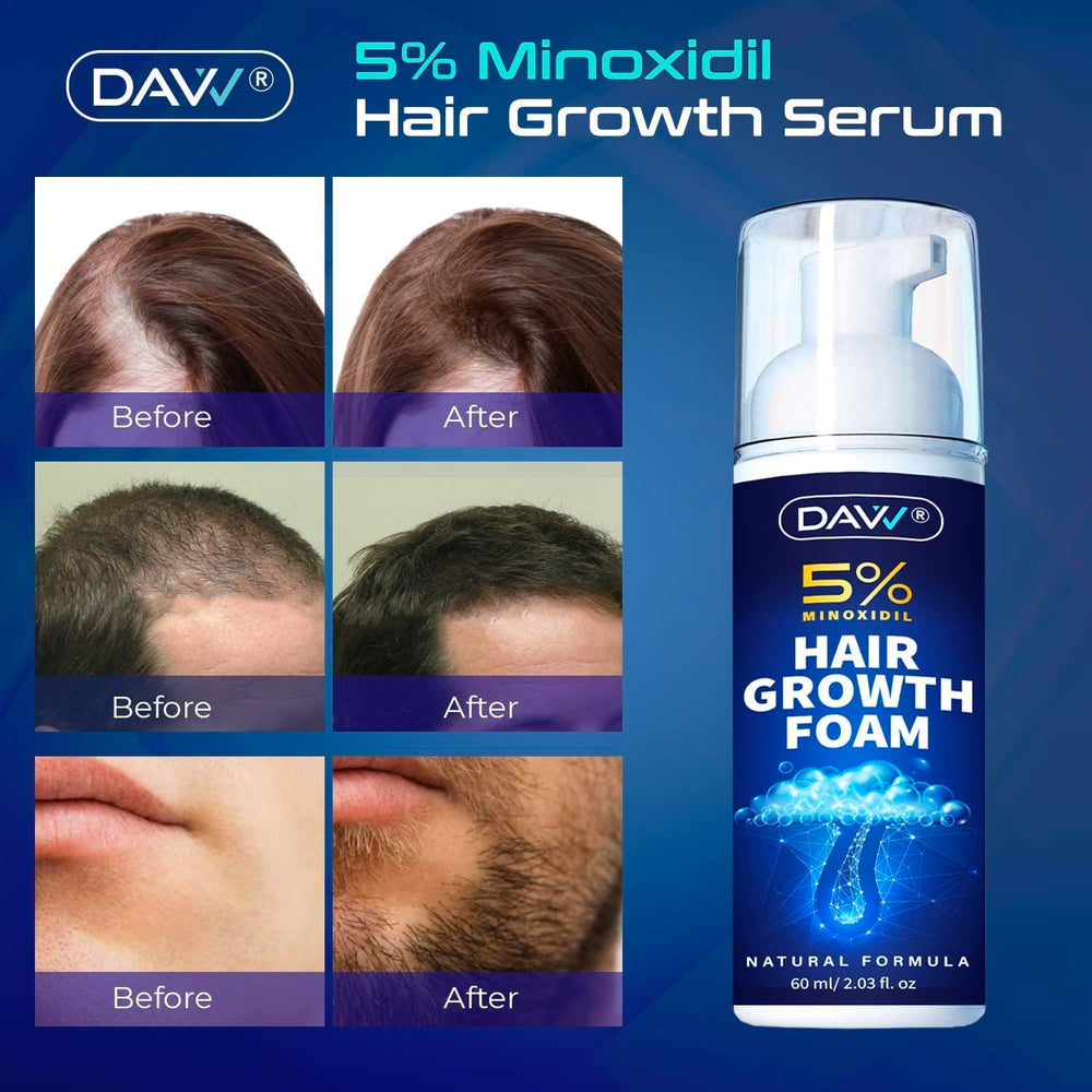 DAVV Minoxidil Foam on scalp shows quick-drying formula for fast absorption.