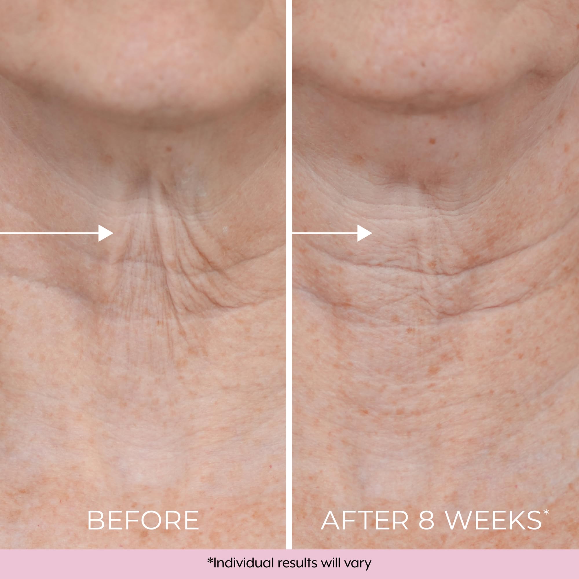 DEKLIDERM neck and chest area care for décolletage