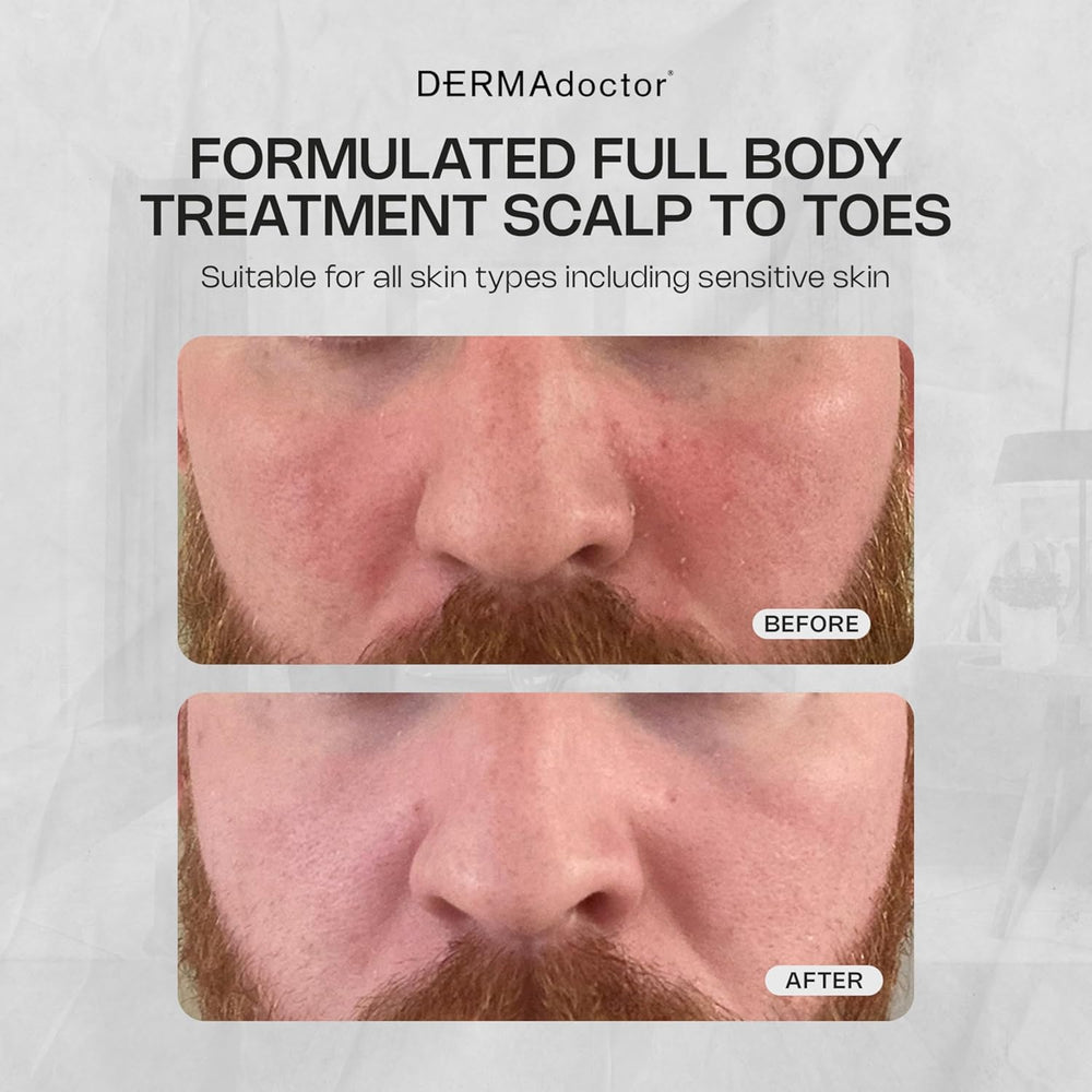 DERMAdoctor Seborrheic Dermatitis Face Wash rich lather cleanses face, body, and scalp with ease.