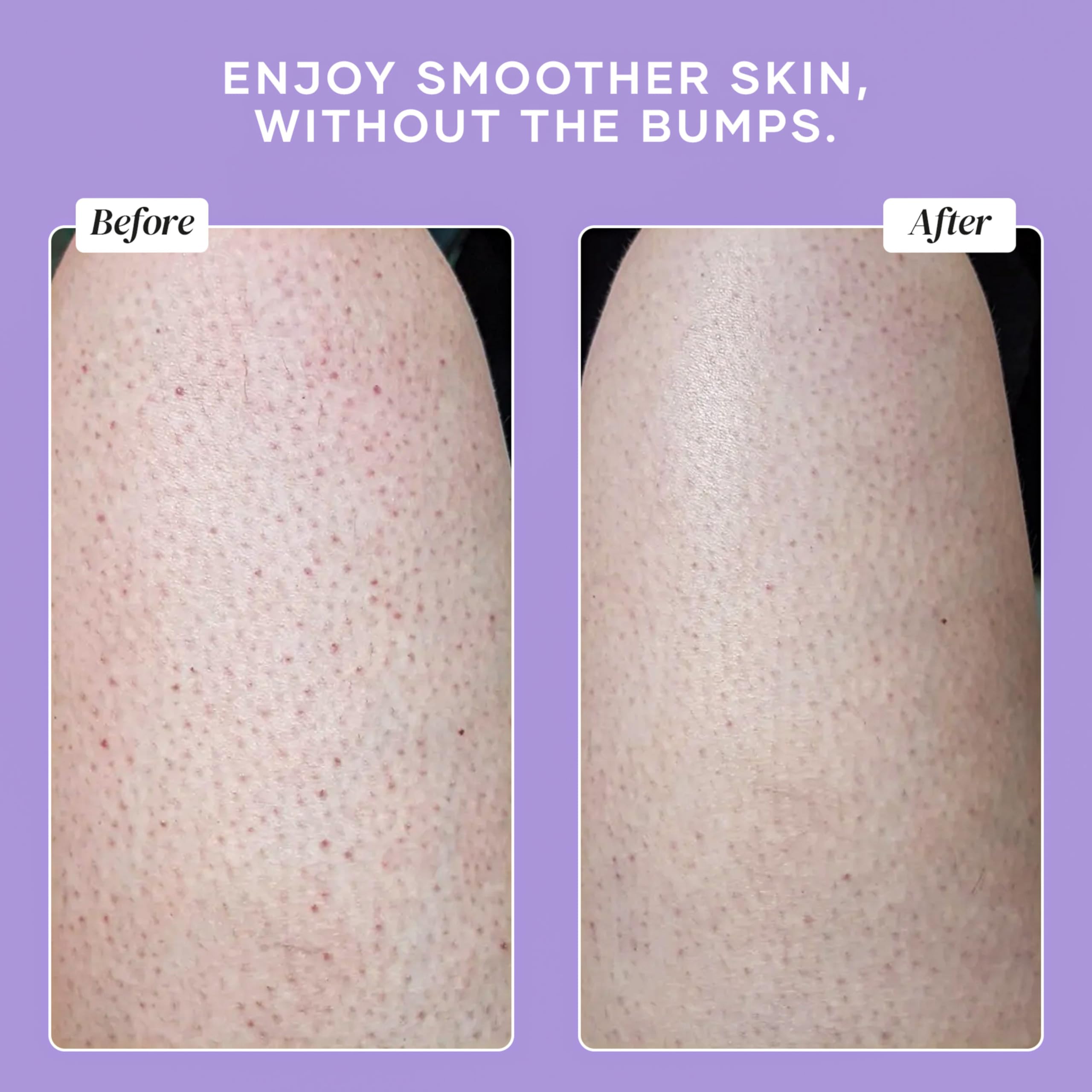 DERMAdoctor KP Bump Eraser Scrub used as pre-shaving prep on legs.