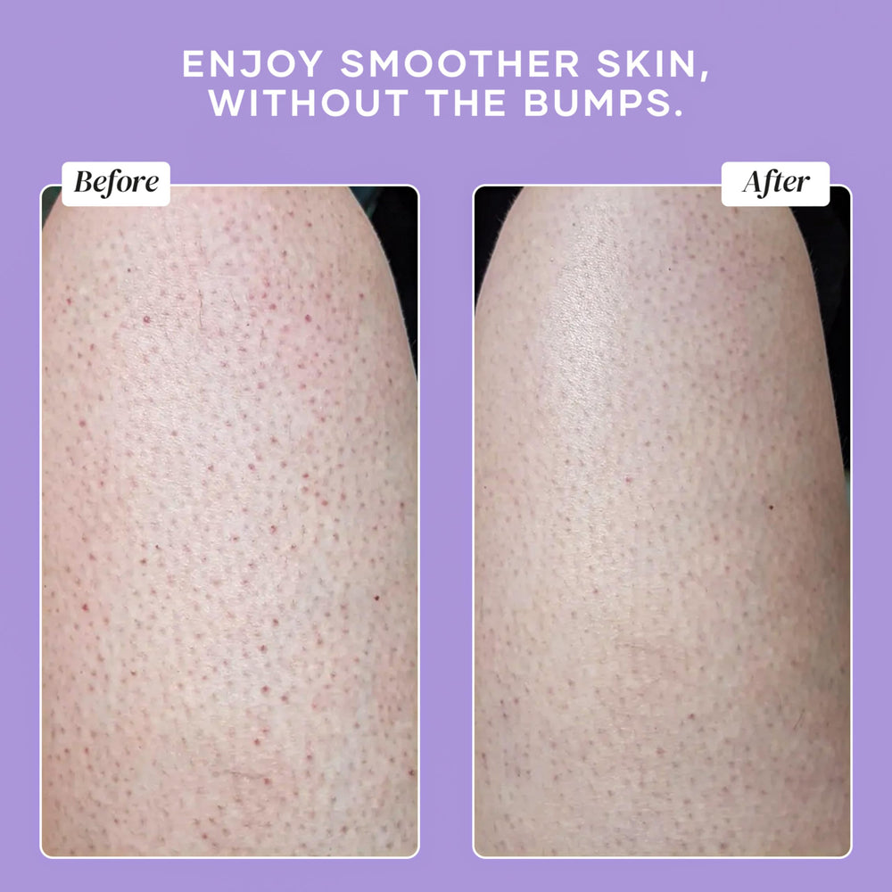 DERMAdoctor KP Bump Eraser Scrub used as pre-shaving prep on legs.