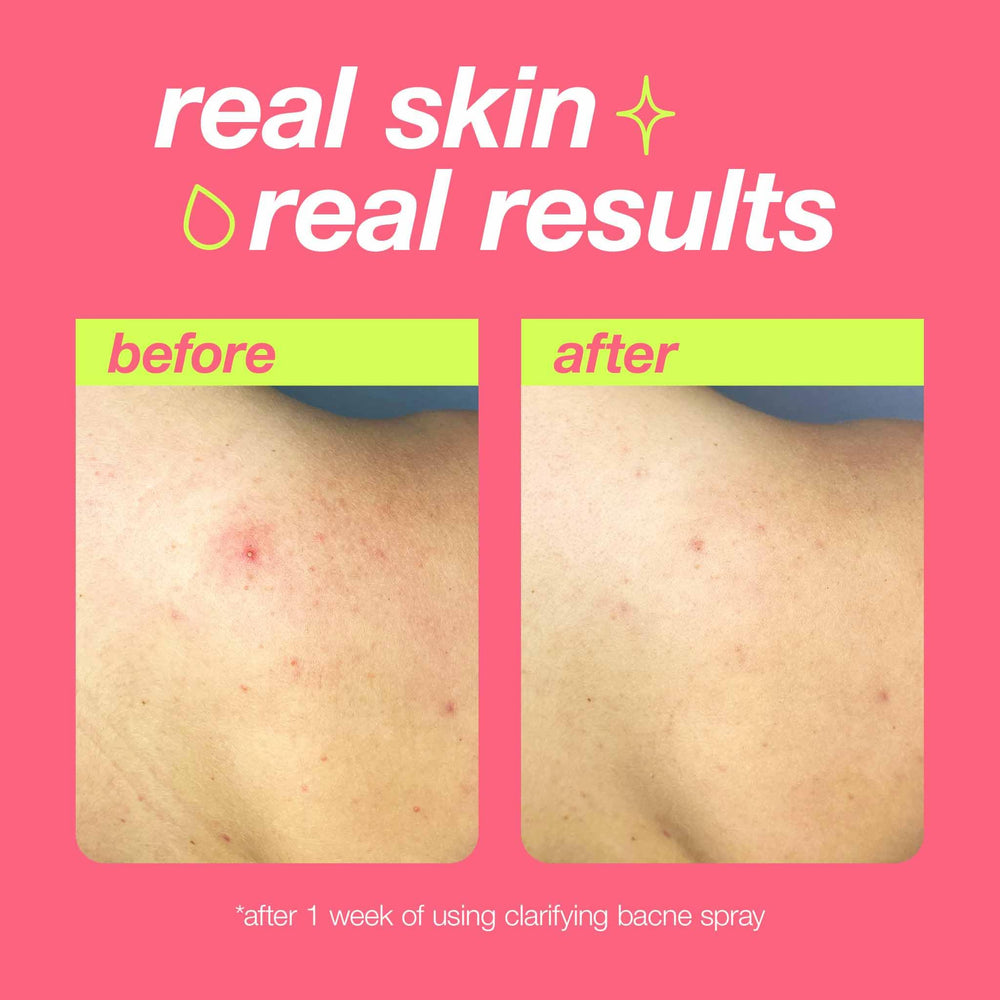 Dermalogica Clear Start bacne spray featuring tea tree oil calms redness and controls oil.