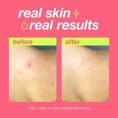 Dermalogica Clear Start bacne spray featuring tea tree oil calms redness and controls oil.