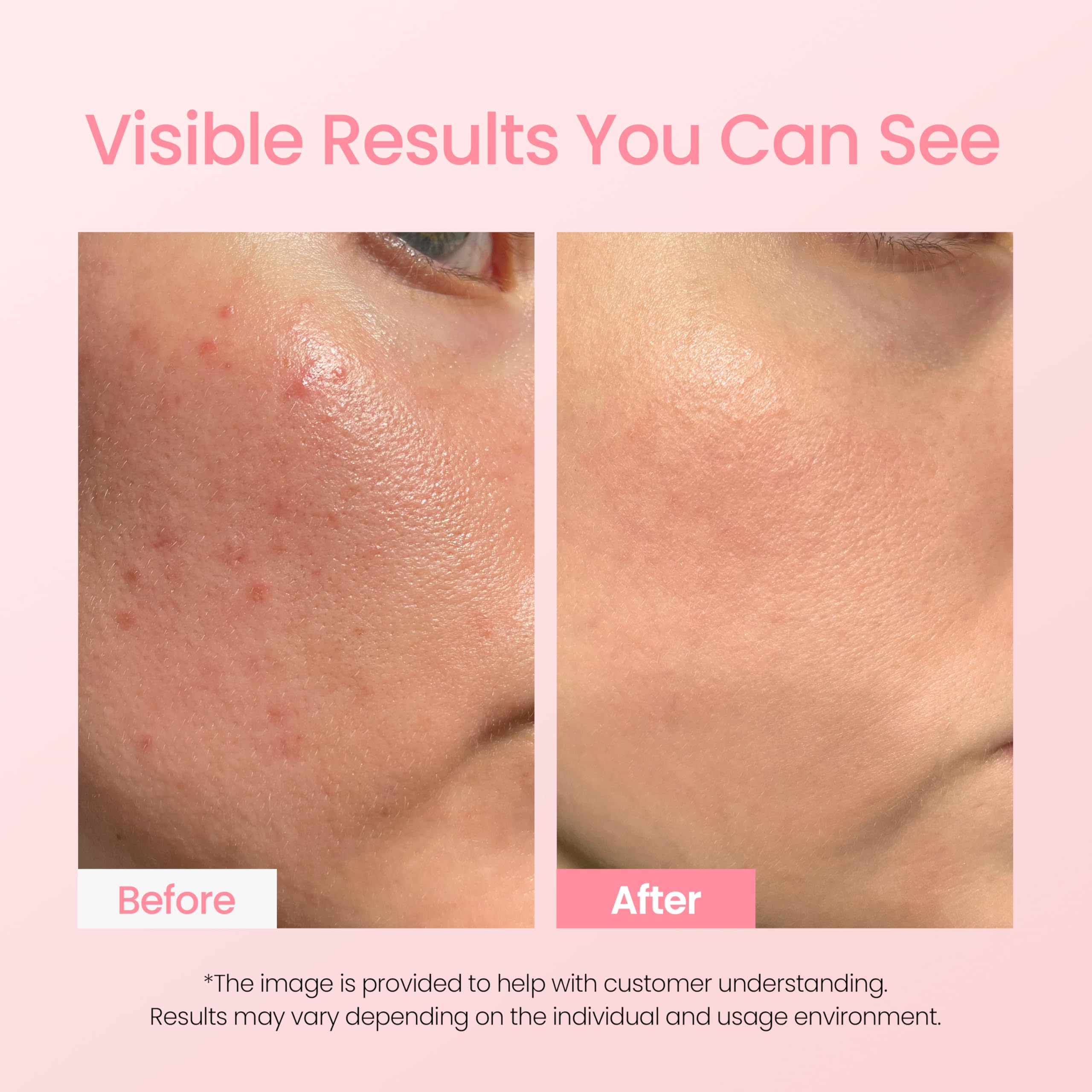 DERMALOGY A-Clear azulene redness reduction shown for calmer-looking skin.