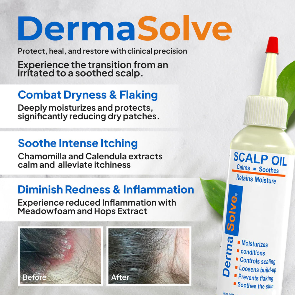 Dermasolve scalp oil dropper demonstrates precise application for targeted relief