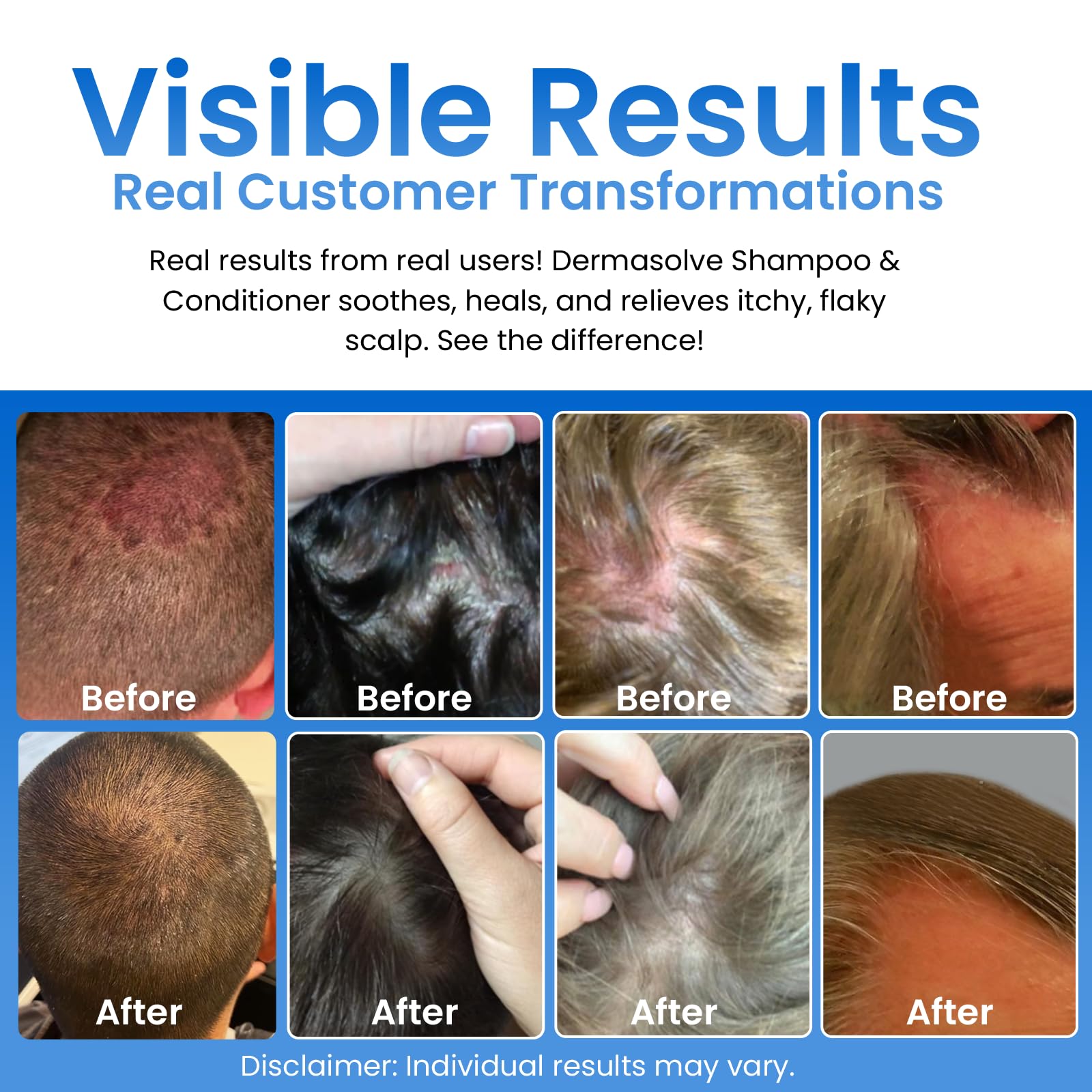 Dermasolve shampoo foamy-lather demonstrating gentle cleansing for irritated scalp