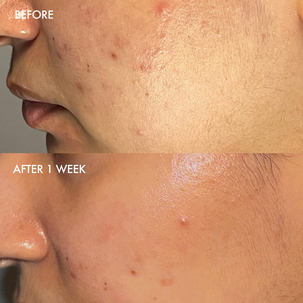 Dermisa sulfur bar in bathroom scene conveys everyday acne-prone skincare routine.