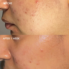 Dermisa sulfur bar in bathroom scene conveys everyday acne-prone skincare routine.