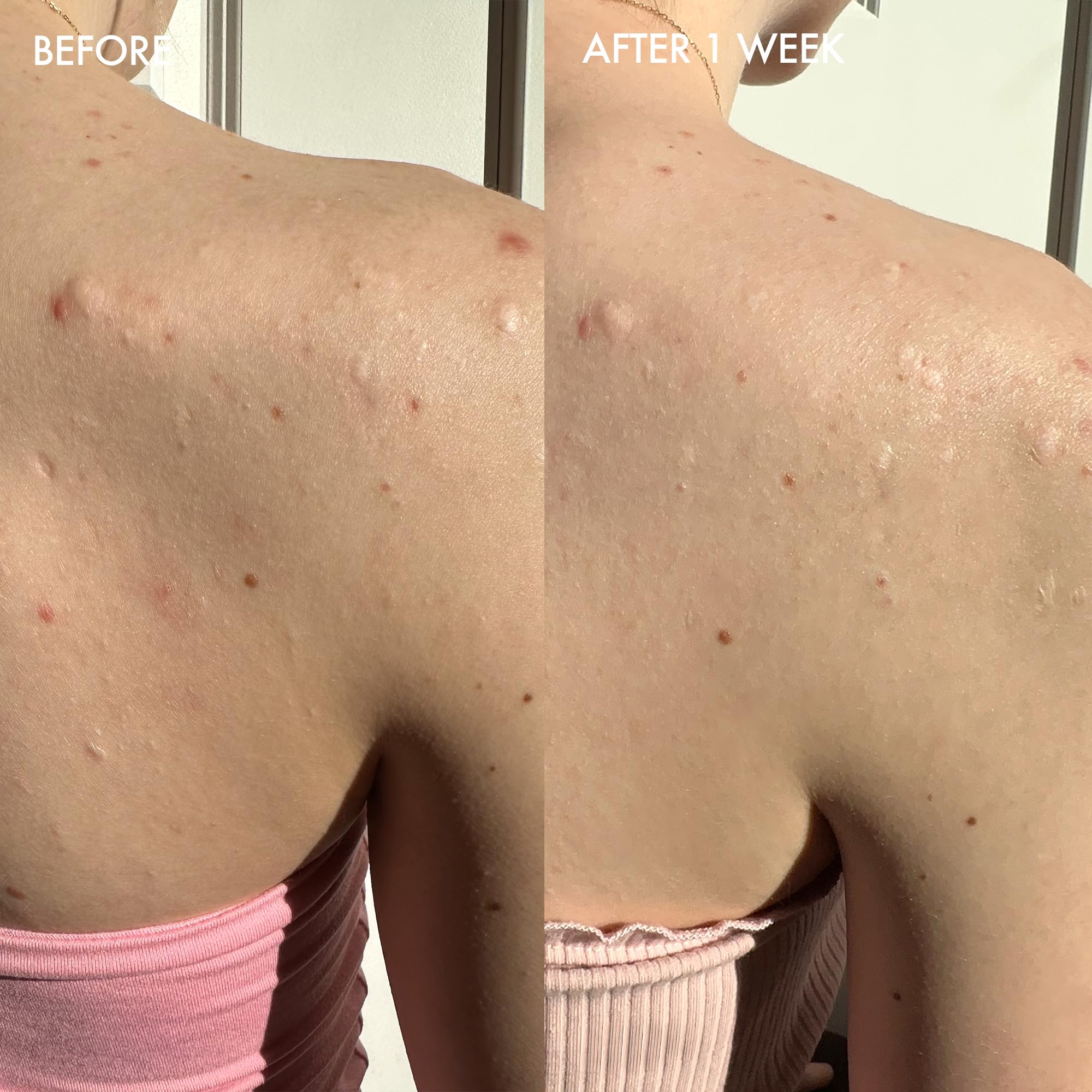 Dermisa sulfur bar aloe-vera on hands applying to face for oil control.