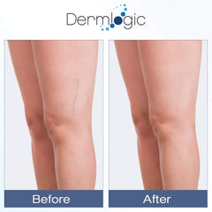 Dermlogic Vitamin K Cream bruising area close-up suggests potential reduction in bruising visibility.
