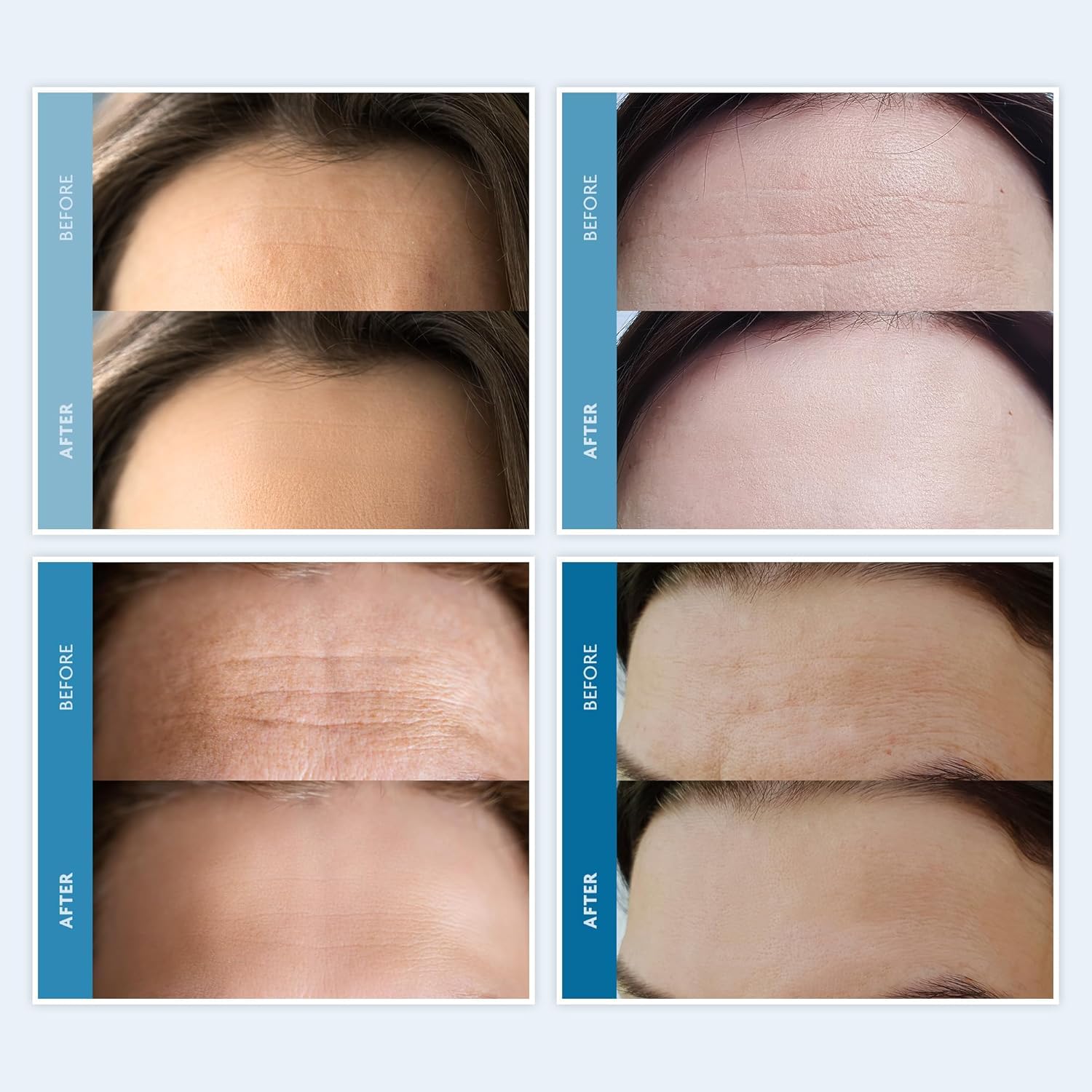 Dersie silicone patch application on skin—secure adhesion overnight