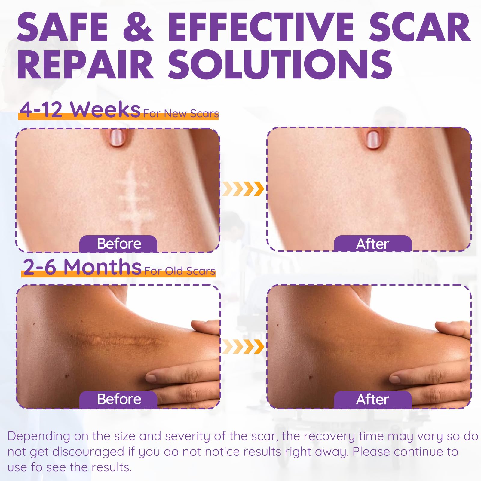 DFK silicone scar sheets demonstrating easy adhesion and conforming fit.