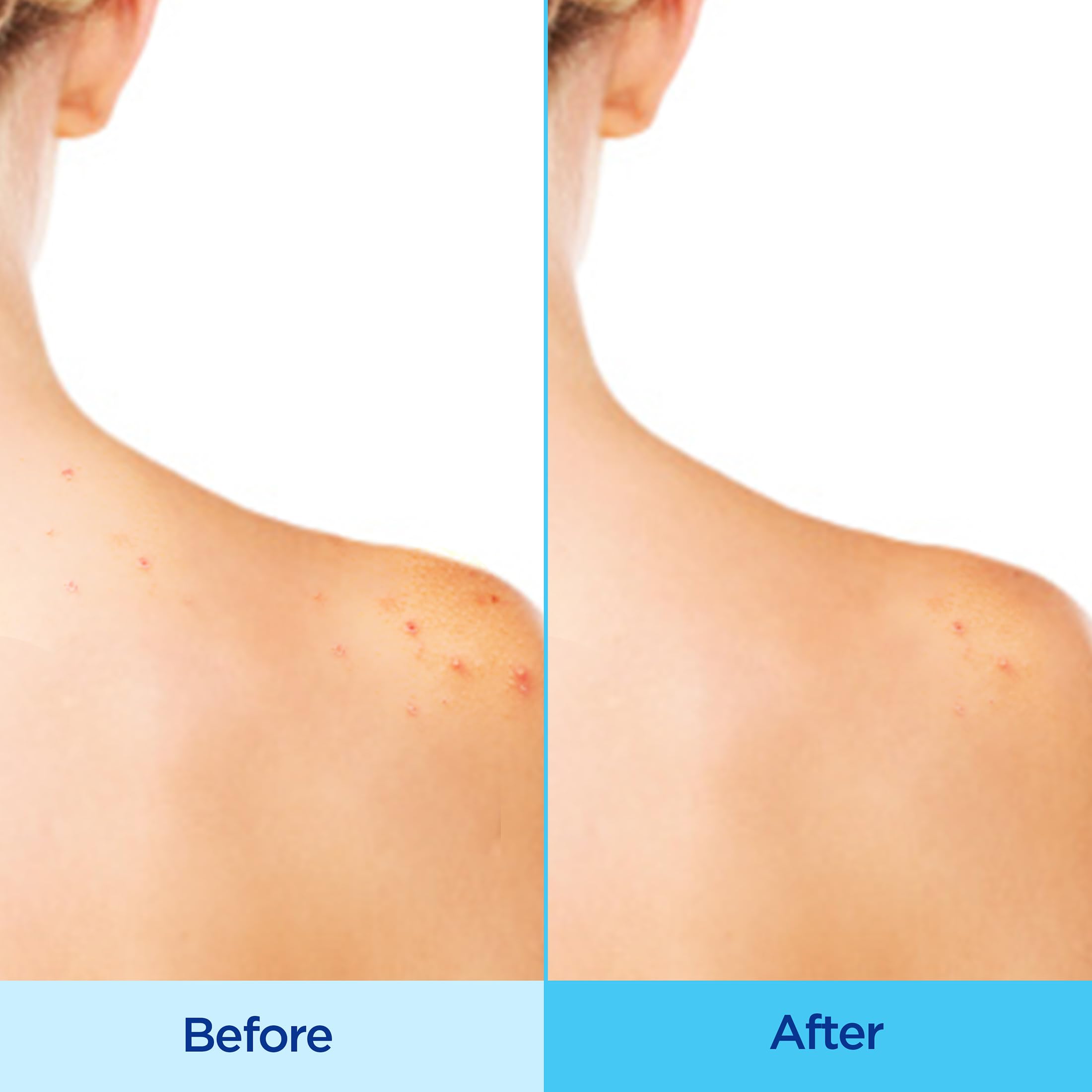 Differin Acne-Clearing Body Spray chest application shown for balanced treatment.