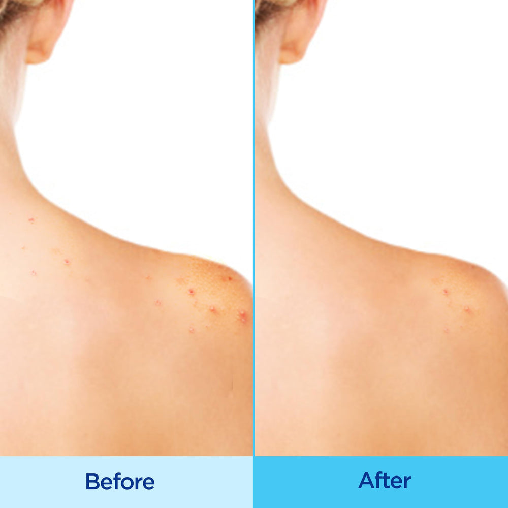 Differin Acne-Clearing Body Spray chest application shown for balanced treatment.